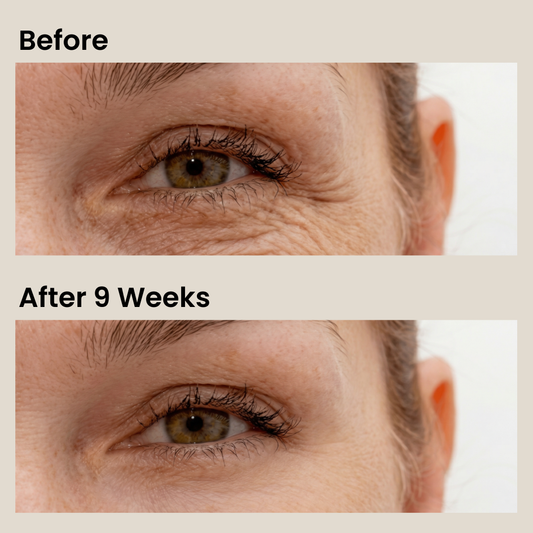 Kyne Micro Infusion Patches